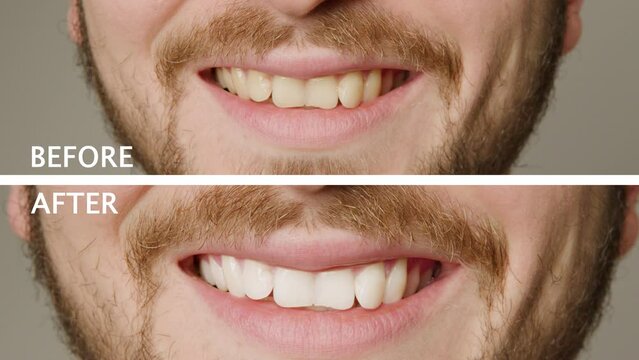 Collage of two superimposed pictures without background, before and after, with white writing, with man's teeth. Teeth whitening treatment. Man smiling broadly after teeth whitening procedure