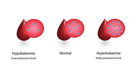 Hyperkalaemia, high plasma potassium level and Hypokalaemia, low plasma potassium level. Potassium K excess and deficit electrolyte disorders, blood test tube, Scientific design. Vector illustration.