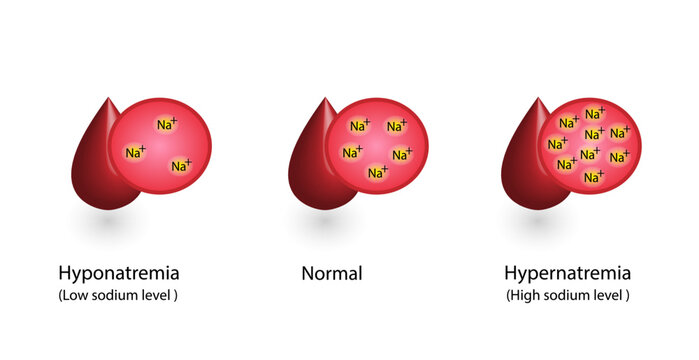 Hypernatremia, high plasma sodium level and Hyponatremia, low plasma sodium level. Sodium Na excess and deficit electrolyte disorders, blood test tube, Scientific design. Vector illustration.