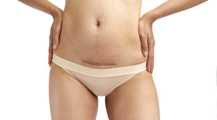 Fototapeta na wymiar Closeup of woman belly with a scar from a cesarean section with her hands on white background