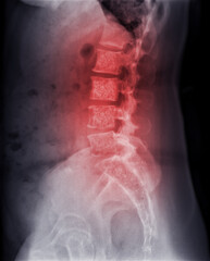 X-ray image of lambosacral spine or L-S spine showing Bone metastasis . - obrazy, fototapety, plakaty