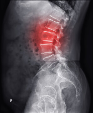 X-ray image of lambosacral spine or L-S spine showing lesion at L3.