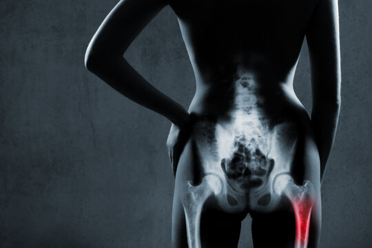 Human femur in x-ray on gray background. Painful femur is highlighted by red color. X-ray image of painful thigh-bone in woman. Right thigh-bone at red area mark.