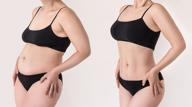 Young woman in black lingerie before and after weight loss on white background. Two shots of female belly with excess fat and toned stomach before and after losing weight. Result liposuction sports