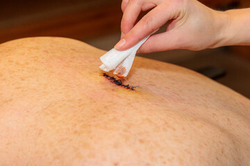 A hand cleans a double sutured scar from abscess surgery on a back with iodine and a swab - obrazy, fototapety, plakaty