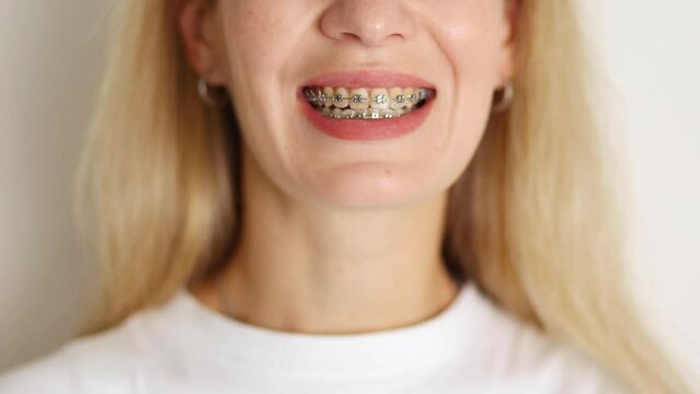 Blonde girl wearing dental braces smiling several times showing her teeth, woman in white t shirt smiles with brackets, view on smile