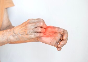 Asian woman scratching her hand. Concept of itchy skin diseases such as scabies, fungal infection,...