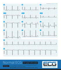 Note that the V3 lead of this ECG shows that the amplitude of R wave is greater than the amplitude of S wave, and there is counterclockwise rotation.