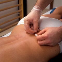 Acupuncturist performing acupuncture on a clients back
close up