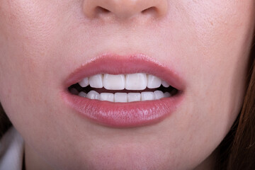 Obraz premium Dental Veneers: Enhance Your Smile with Cosmetic Dentistry.