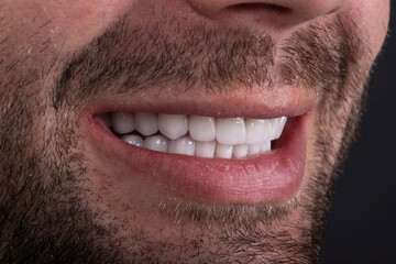 Transform Your Smile with Veneers: Dentistry and Restorative Dental Solutions