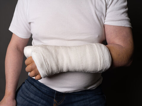 Hand in plaster, big bruise on hand. Cropped photo of a man. After surgery. Joint replacement. Prerel.