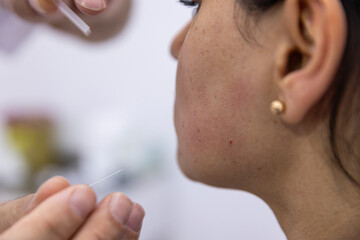 Dry needle treatment. A portrait of a small acupuncture needle sticking in a person's face next to the nose, to heal pain, relieve stress or another medical condition with alternative medicine.