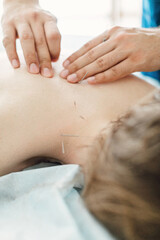 Woman stabbed in the back with needle in bright acupuncture clinic
