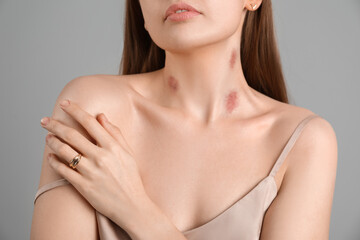 Young woman with love bites on her neck against grey background, closeup