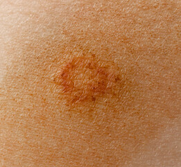 Fototapeta premium lichen on the skin as a background