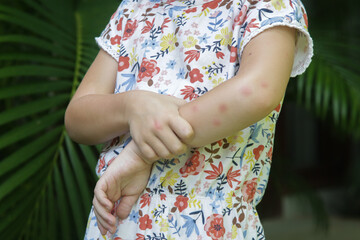 Little girl has skin rash from allergy or mosquito bites