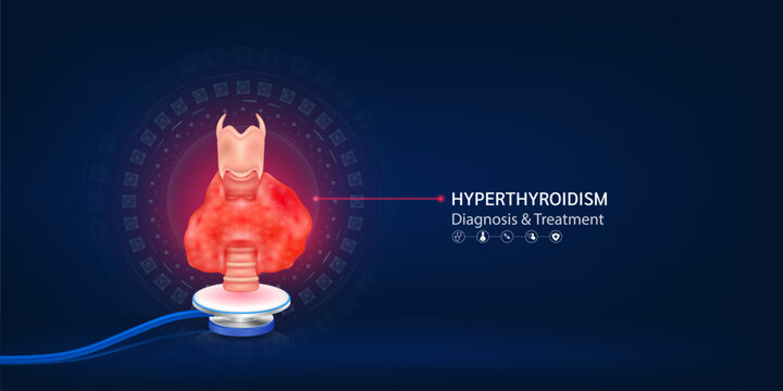 Hyperthyroidism disaster, Human thyroid gland model float away from stethoscope. Doctor diagnosis treatment. Medical technology innovation concept. Banner design for pharmacy clinic. 3d Vector.