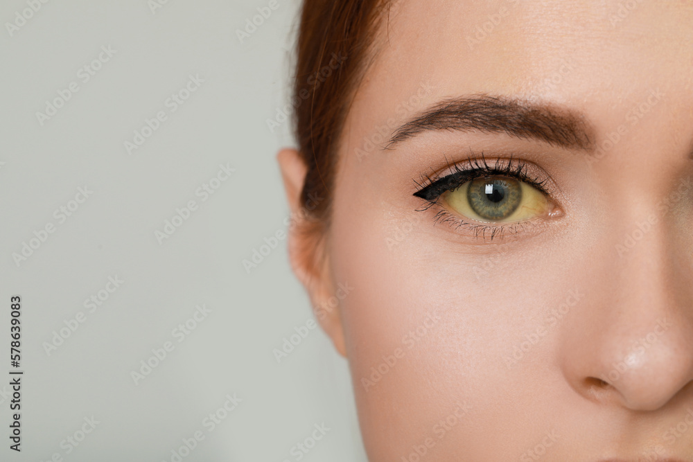 Canvas Prints Closeup view of woman with yellow eyes on light grey background, space for text. Hepatitis symptom