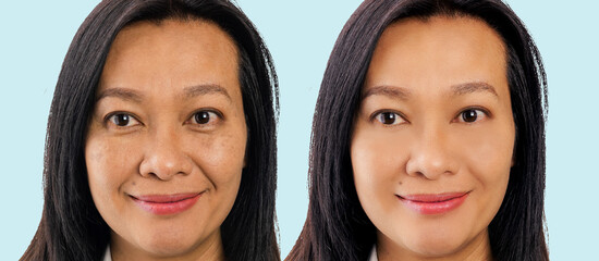 Retouched image to show before and after treatment spot melasma pigmentation facial skin care...