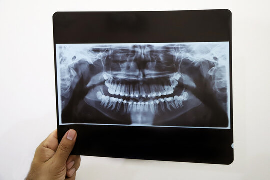  X-ray of a denture with brackets. X-ray of the mouth of an adolescent with orthodontics. Dentist looking at x-ray. dentist hand holding x-ray of a patient with fixed orthodontic braces. Dental health
