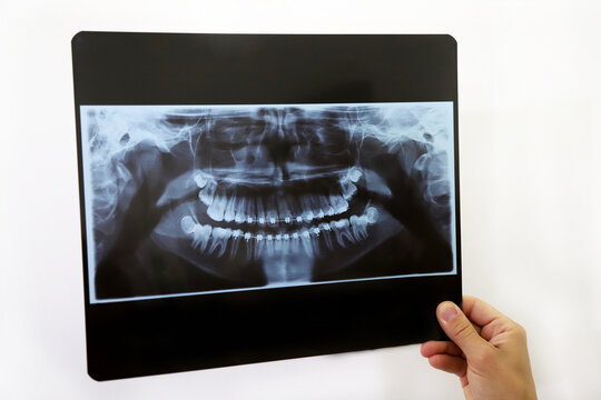 X-ray of a denture with brackets. X-ray of the mouth of an adolescent with orthodontics. Dentist looking at x-ray. dentist hand holding x-ray of a patient with fixed orthodontic braces. Bone scan.