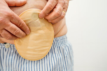closeup of an unrecognizable man with an ostomy bag. international colon cancer day