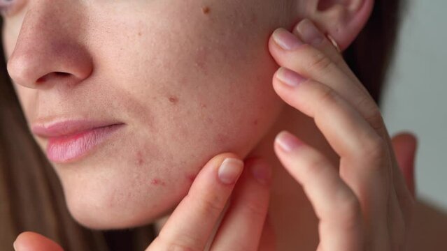 Young woman suffering from problem skin