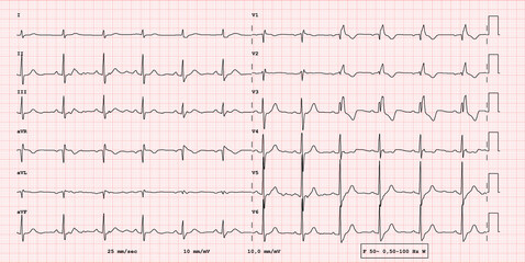 ECG example of  12-lead rhythm,  instable right bundle branch block, real exam