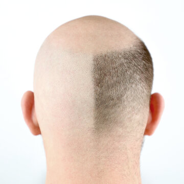 Bald man, rear view. Baldness close-up. Loss of hair on the head. Bald head. Hair transplantation, care and treatment. Severe baldness. Half-shaved head. An unshaven man