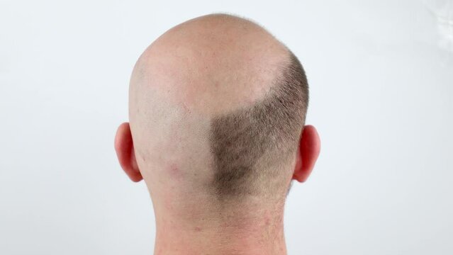 Bald man, rear view. Baldness close-up. Loss of hair on the head. Bald head. Hair transplantation, care and treatment. Severe baldness. Half-shaved head. An unshaven man