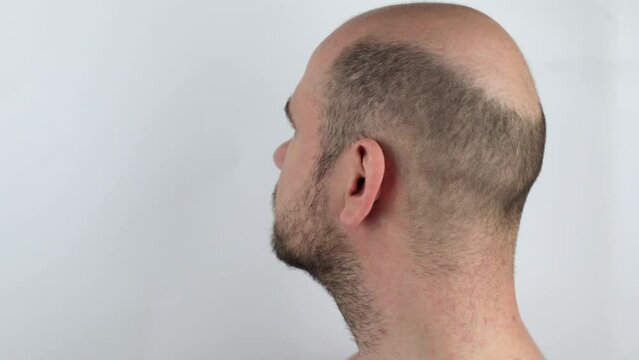 Bald man, rear view. Baldness close-up. Loss of hair on the head. Bald head. Hair transplantation, care and treatment. Severe baldness