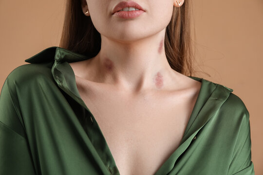 Young woman with love bites on her neck against color background, closeup