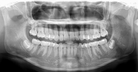 Panoramic dental Xray shows fixed teeth amalgam seal.X-ray for dental problems in toothache patient...