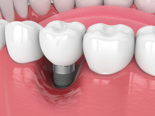 3d render of human jaw with peri implantitis disease