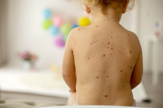 Little toddler girl with chicken pox in bed, playing at home, quarantine isolation