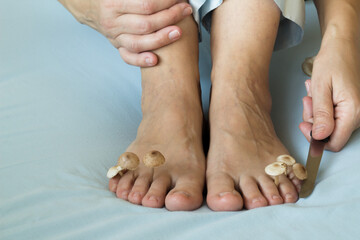 Fungi grow between the toes on the feet. Concept of nail fungus, skin and nail infections. Close-up...