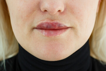 woman asymmetric lips as a result after lip augmentation with hyaluronic acid filler entered...