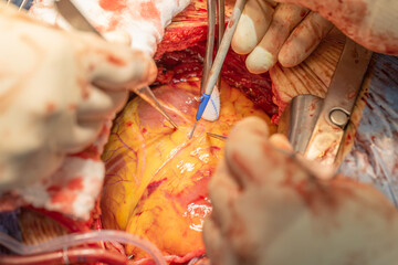 Two heart surgeons prepare a vein to be able to create a bypass on the heart. Concept: health and cardiac surger
