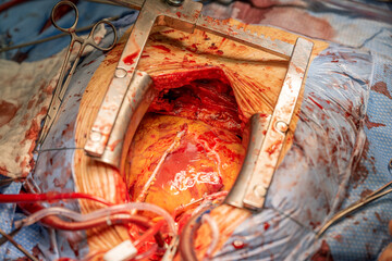 Two heart surgeons prepare a vein to be able to create a bypass on the heart. Concept: health and cardiac surger