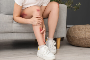 Young woman with bruised legs sitting on sofa at home