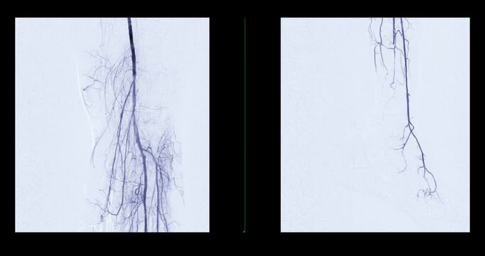 Femoral artery angiogram or angiography 