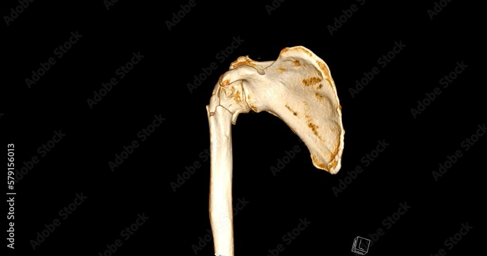 Poster ct scan 3d rendering of left shoulder showing fracture head of humerus .