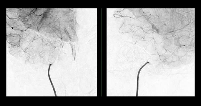 Cerebral angiogram  for diagnosis abnormalities such as cerebral artery aneurysms and cerebral artery disease such as atherosclerosis (plaque).