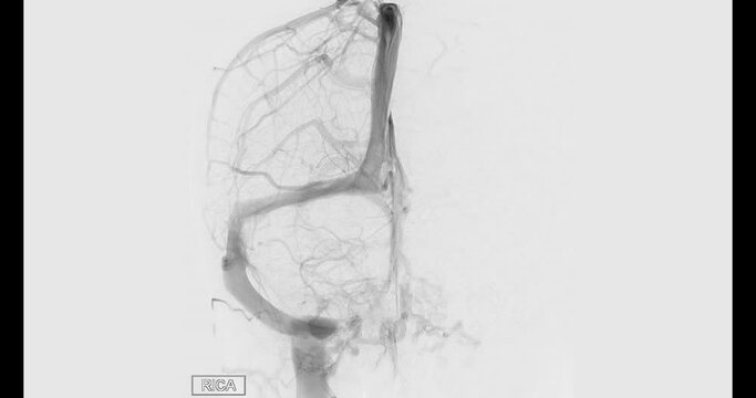 Cerebral angiogram of right cerebral artery  for diagnosis abnormalities such as cerebral artery aneurysms and cerebral artery disease such as atherosclerosis (plaque).