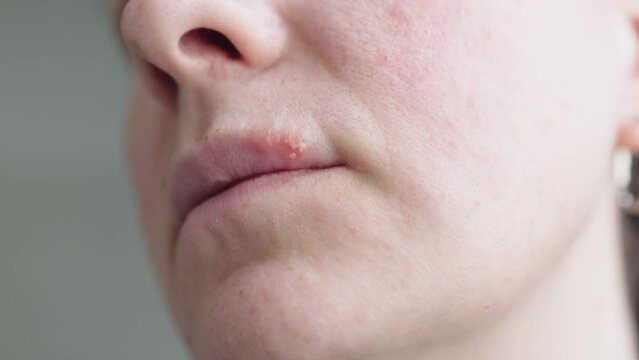 herpes simplex on female upper lip. woman suffering from herpes sore close-up. discomfort from herpes on lips. cold on lips viral disease caused by herpes pus-filled blisters