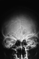 X-ray radiograph of the skull human.