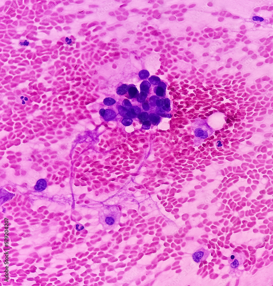 Poster Lungs adenocarcinoma. Malignant cell. Smear show cellular material of atypical epithelial cells, cell show pleomorphism with prominent nuclei and cytoplasm. Lungs cancer.