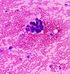 Lungs adenocarcinoma. Malignant cell. Smear show cellular material of atypical epithelial cells,...