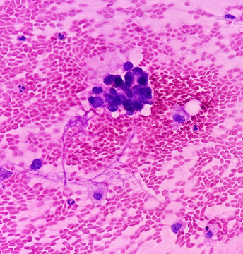 Lungs adenocarcinoma. Malignant cell. Smear show cellular material of atypical epithelial cells, cell show pleomorphism with prominent nuclei and cytoplasm. Lungs cancer.